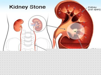 kidney stone